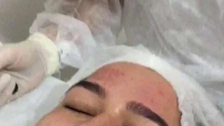 2019 Amazon Top Sale Derma Roller Kit 0.25mm with Vitamin C or Jade Roller Customized Services 